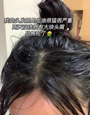 头屑多掉头发,头皮屑多掉头发是什么原因引起的