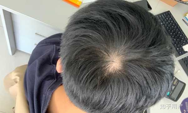 旋在右边，头发往哪边偏好看,偏额会越来越严重吗