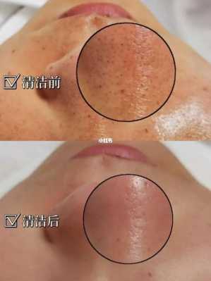 头发毛囊怎么快速去除,头发毛孔堵塞怎么清理用什么洗发水