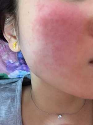 染头发脸上过敏怎么办（染头发脸上过敏怎么办不样不痛）