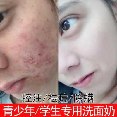 怎么洗脸去痘（怎么洗脸去痘）