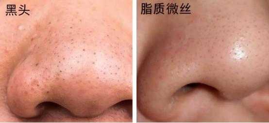 脸上的毛孔堵塞怎么办（毛孔堵塞可以挤出来吗）