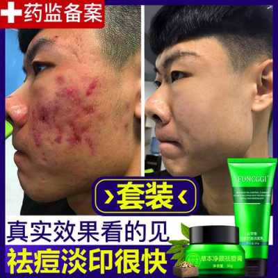 涂什么可以淡化痘印,涂什么去痘印快