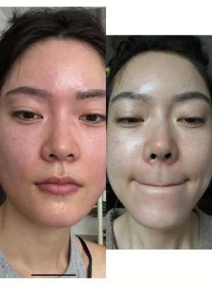 鼻头毛孔大怎么收缩（鼻子毛孔变大了怎么收缩）
