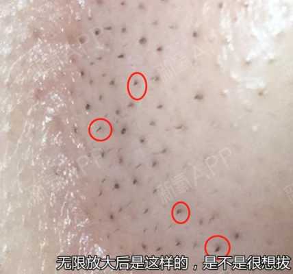 鼻子上长黑头是什么原因（鼻子上长黑头是什么原因）