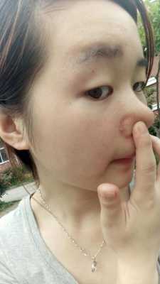 鼻子上有粉刺怎么办,