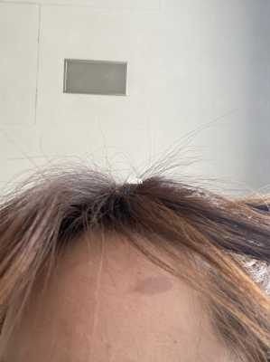 被卷发棒烫伤后怎么处理（卷发棒怎样快速降温）