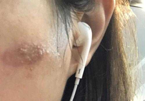 被卷发棒烫伤后怎么处理（卷发棒怎样快速降温）