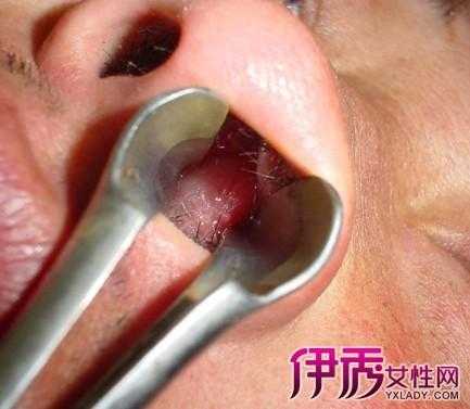 鼻子上长火疙瘩怎么办（鼻子里总起火疙瘩是什么原因）