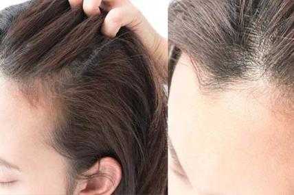 头发糟怎么办（头发糟怎么办女生）