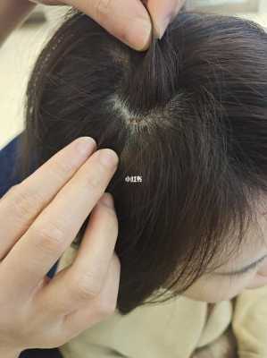 染发以后头皮痒怎么办（染头发头皮有刺激正常吗）