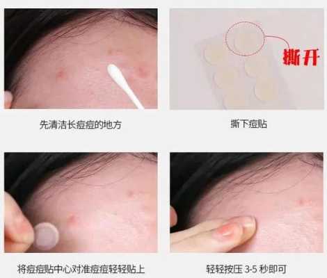 怎么快速消除痤疮（怎么快速消除痤疮痘痘）