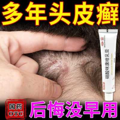 头皮瘙痒怎么治疗（头皮发痒,头上起包是什么病,用什么药好）