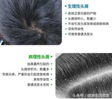 头顶头皮痒而且还脱发是什么原因,头皮发痒脱发怎么办啊