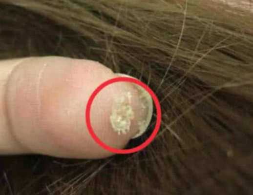 头顶头皮痒而且还脱发是什么原因,头皮发痒脱发怎么办啊