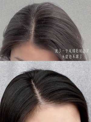 为什么留长发头屑会变多,头发头皮多怎么办怎么才能去掉