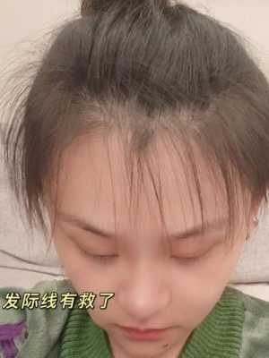 额头碎发多是什么原因（女孩子额头碎发多怎么办）
