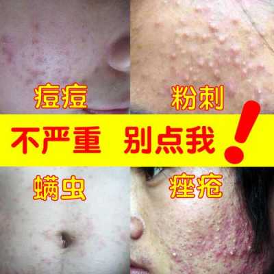 擦什么去痘印（脸上有痘印怎么消掉）