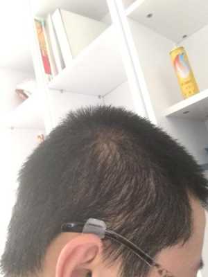 头发少是什么病（头发少是什么病的前兆）