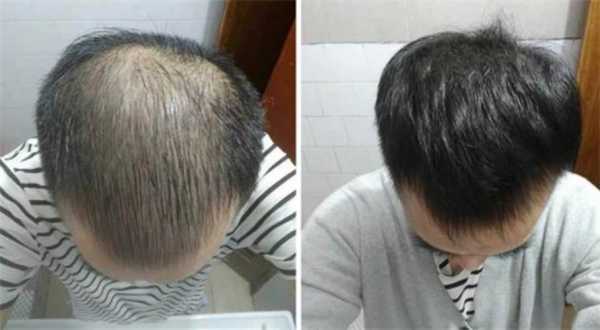 头发少是什么病（头发少是什么病的前兆）
