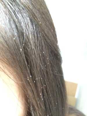 头皮屑太多了怎么去除（头皮屑太多了怎么去除小妙招）