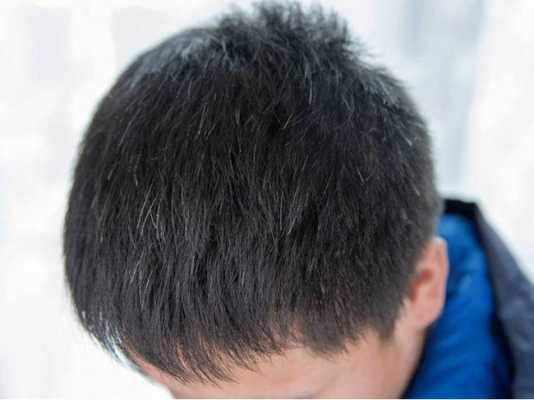 为什么少年会长白头发（为什么少年会长白头发?）