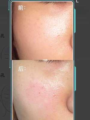 脸上毛孔怎么收缩（脸上毛孔怎么收缩最快）