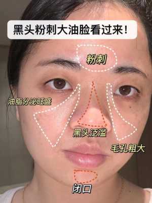 脸颊黑头怎么去除（脸颊黑头怎么去除最有效）