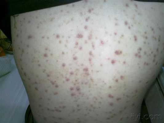 脸上背上长痘痘是什么原因（后背长痘痘是什么原因，是湿气太重吗）