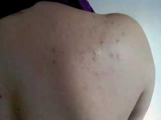 脸上背上长痘痘是什么原因（后背长痘痘是什么原因，是湿气太重吗）