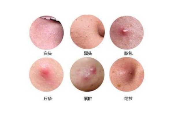 快速治疗痤疮最有效的方法有哪些,怎么消除脸上的痤疮杆菌