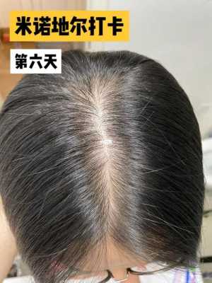 头皮痒脱发怎么办,脂溢性脱发头皮痒怎么办