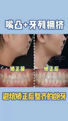 凸型脸怎么（凸型脸怎么矫正）