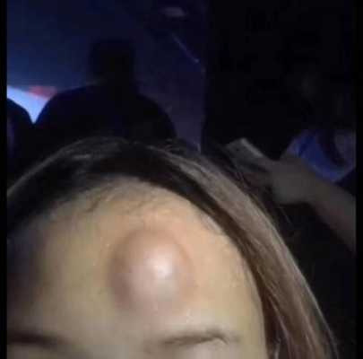 头上撞了包，好久了，还没消下去，怎么处理,头皮不好怎么调理