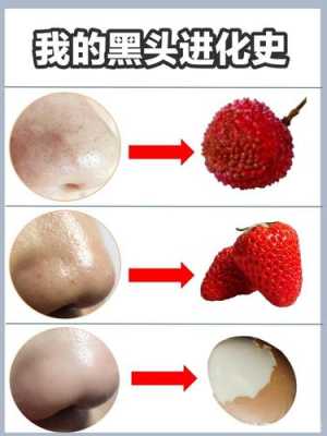 怎么去黑头吗（如何去除黑头）