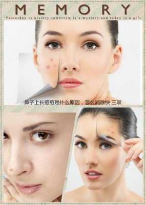 为什么鼻子上长痘痘怎么办（鼻子上面长痘痘原因）