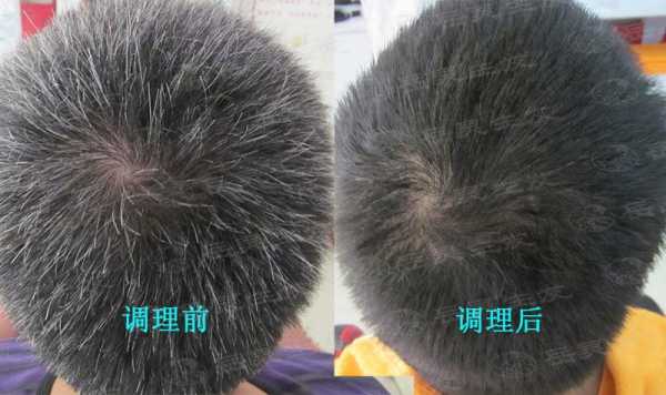 前额有很多白发这个症状该怎么调理呢,头顶白发吃什么药能变黑