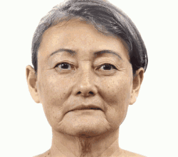 动态眼纹怎么消除（额头眼角皱纹怎么去除）