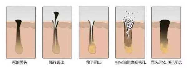 怎么样可以去掉黑头,黑头怎么能去掉不再长