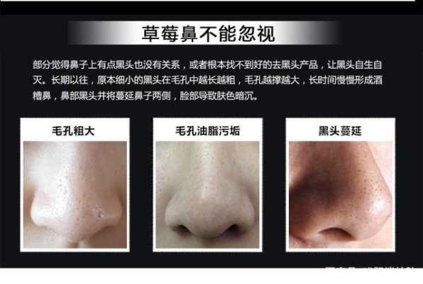 怎么样可以去掉黑头,黑头怎么能去掉不再长