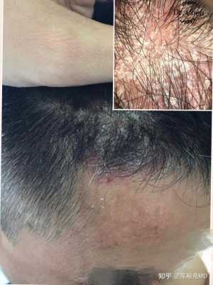 染发后头皮屑多是什么原因（染完头发为什么有头皮屑）