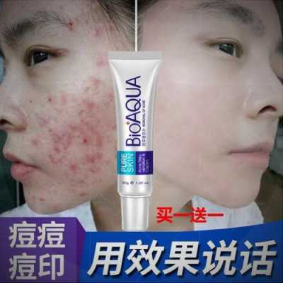 闭口涂什么,涂什么去痘痘效果最好