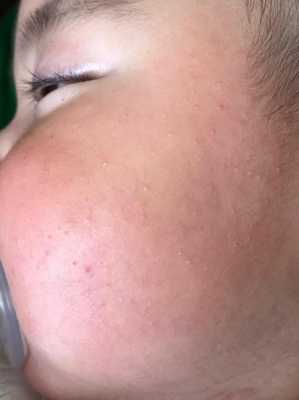 脸上长脂肪粒怎么办,小孩脸有脂肪粒怎么办