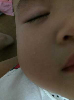 脸上长脂肪粒怎么办,小孩脸有脂肪粒怎么办