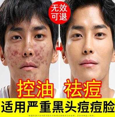 用什么洗脸可以有效祛除痘印,用什么洗脸能去痘印吗