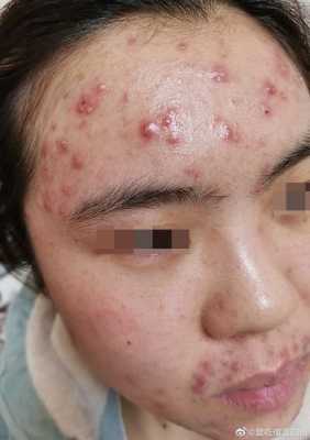 有暗疮怎么办（有暗疮怎么办才能消除）