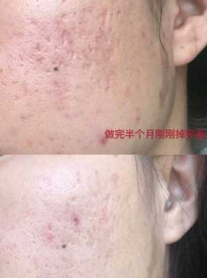 祛痘印真实有效的方法,怎么样去痘印最有效果