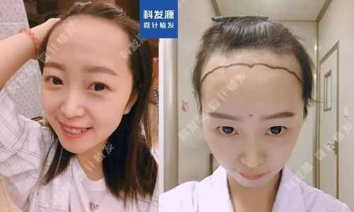 头发怎么3天长5厘米（种植发际线一般多少钱啊）