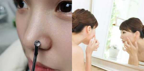 白头粉刺怎样去除,白粉刺怎么去除小妙招