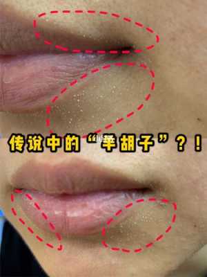 白头粉刺怎样去除,白粉刺怎么去除小妙招